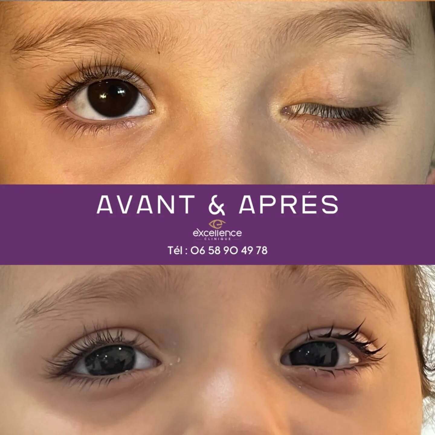 Résultat après chirurgie complète du ptosis à Excellence Clinique Ophtalmologique à Alger