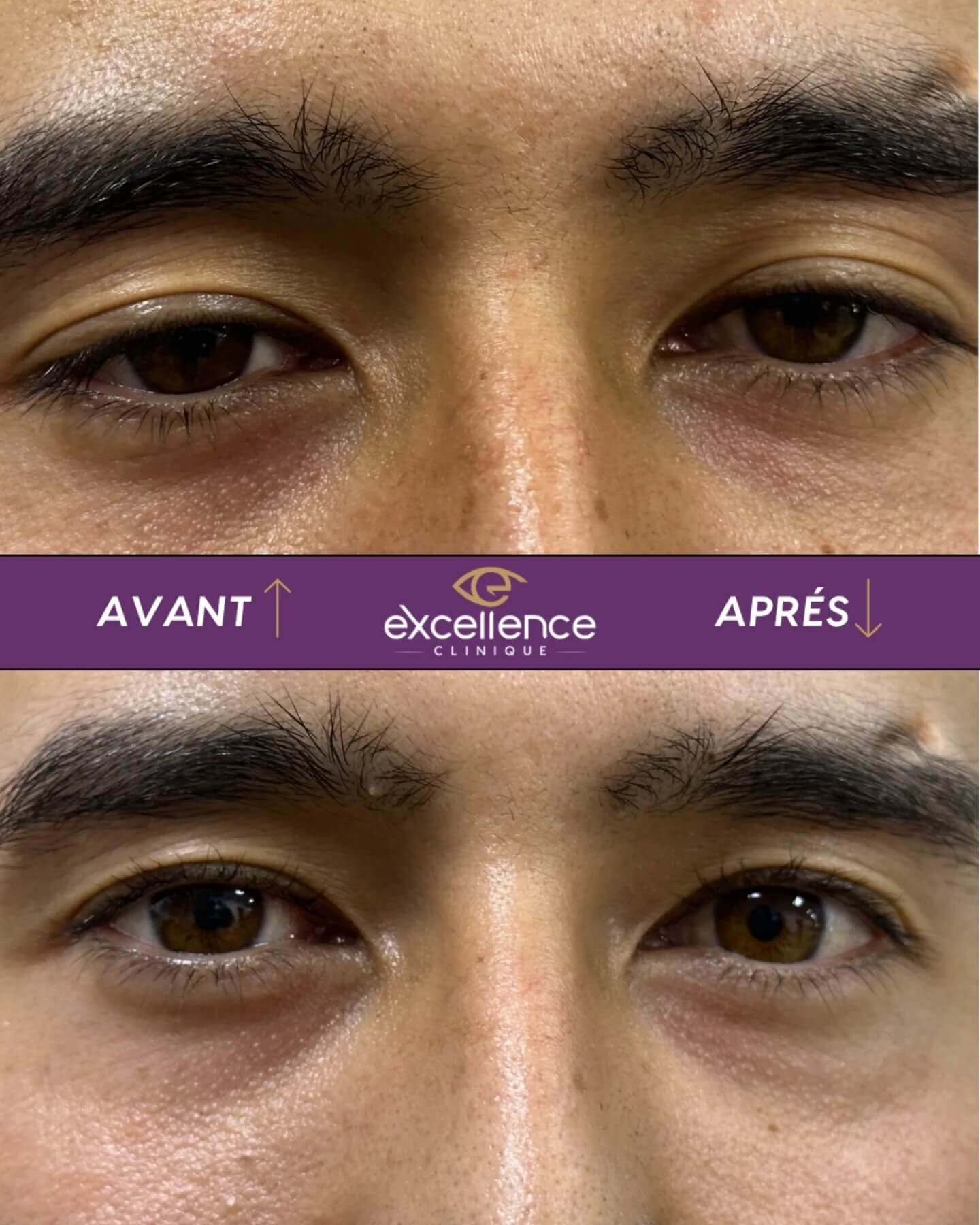 Résultat après une chirurgie du ptosis réalisée à Excellence Clinique Ophtalmologique à Alger