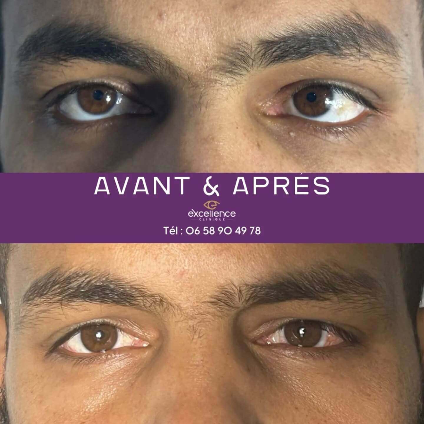 Résultat après chirurgie du strabisme convergent réalisée à Excellence Clinique Ophtalmologique à Alger