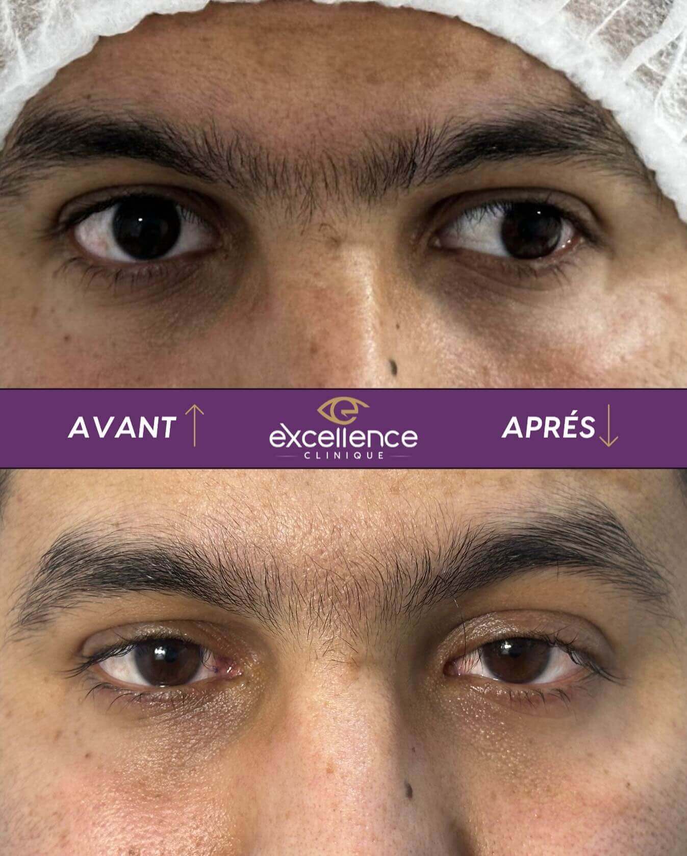 Résultat après une chirurgie du strabisme à Excellence Clinique Ophtalmologique à Alger